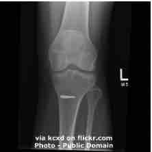 An ESL lesson on Knee Surgery - Knee surgery may do more harm than good